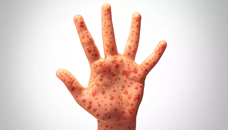 Image: a hand covered in measles marks