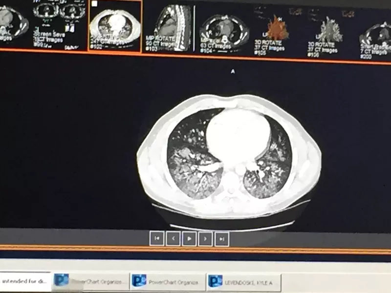 Image: Levendoski said when he compared images of his lungs to pictures on the news of other victims' lungs, "mine looked worse."