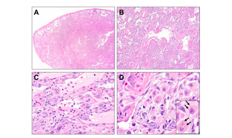 Image: These images show surgical lung biopsies from a 31-year-old woman who died from her vaping-related injuries.